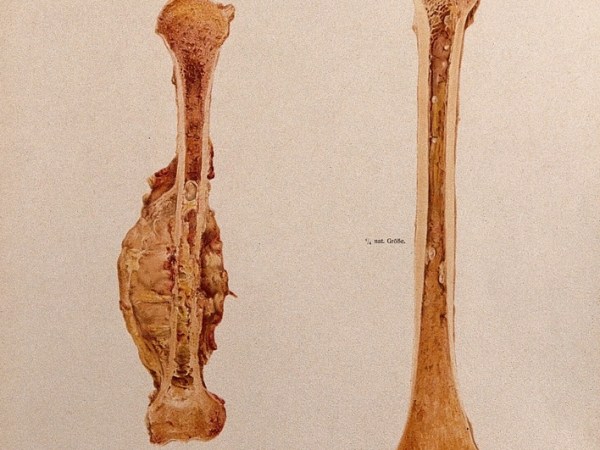 understading bone cancer: causes ,effects, prevention ,and dietary&nbsp;guidance.